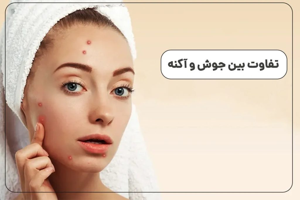 تفاوت بین جوش و اکنه